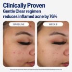 Cetaphil Gentle Clear Mattifying Acne Moisturizer 89ml - Image 2