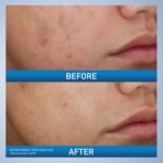 CeraVe Acne Foaming Cream Wash – 150ml - Image 3