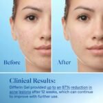 DIFFERIN Adapalene 0.1% Acne Treatment Gel 15g - Image 2